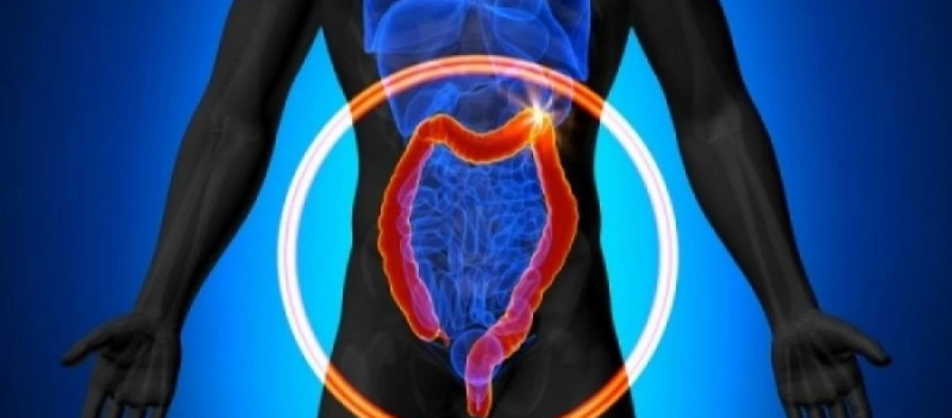 Οι επικίνδυνοι πολύποδες του παχέος εντέρου και πώς αντιμετωπίζονται